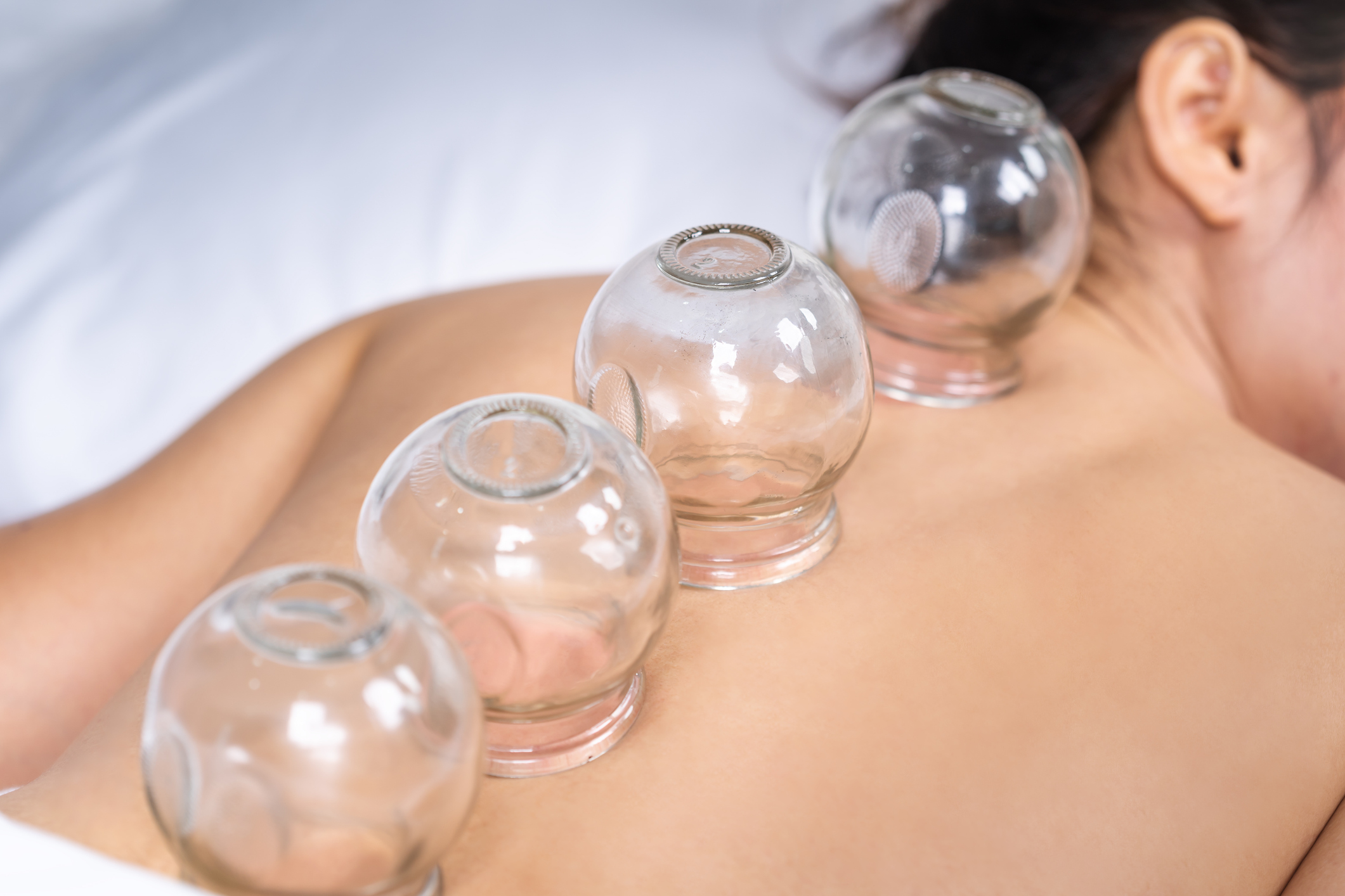 Woman Receiving Cupping Treatment On Back