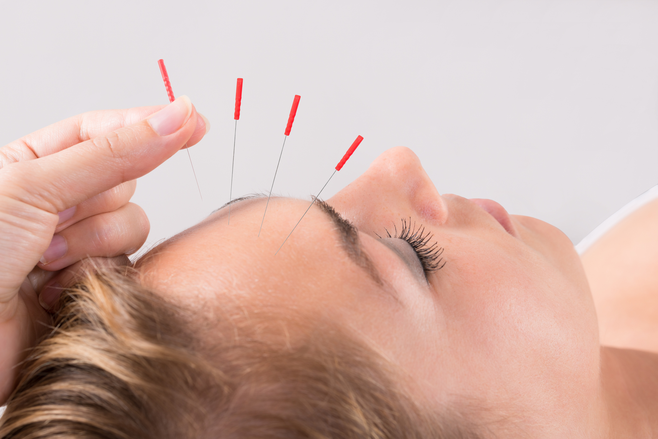 Hand Performing Acupuncture Therapy On Head